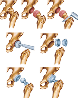 Instalace endoprosthesis