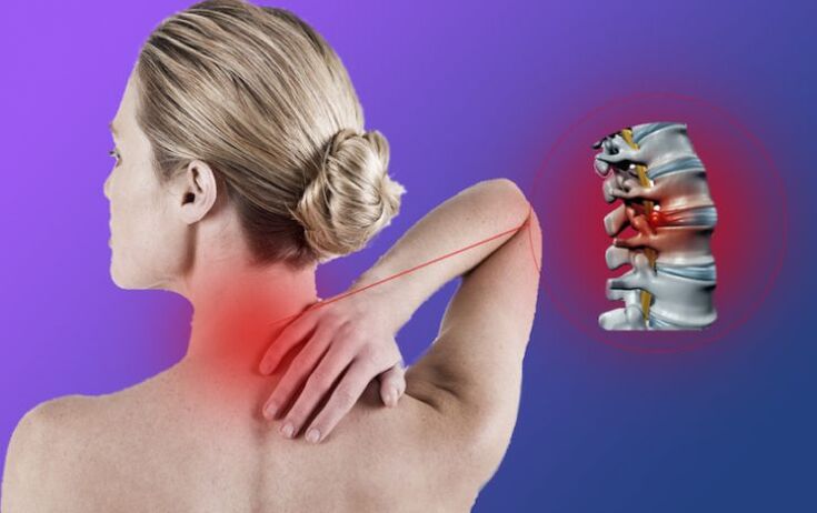 Zánět páteře s cervikální osteochondózou