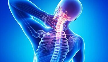 Komplikace osteochondrosy krční páteře