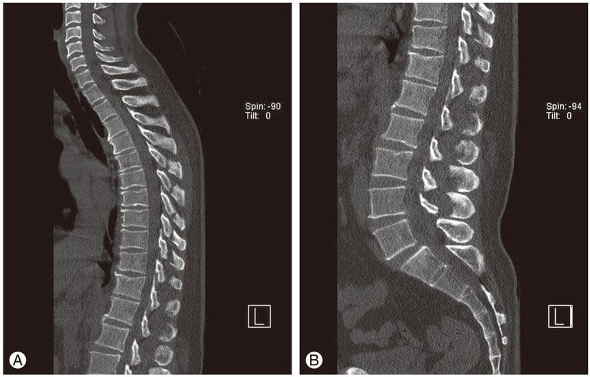 Deformace meziobratlových plotének na MRI obrazech u hrudní osteochondrózy