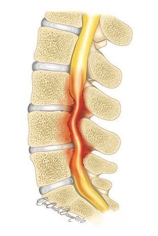 Při osteochondróze hrudní páteře dochází ke stlačení páteřního kanálu
