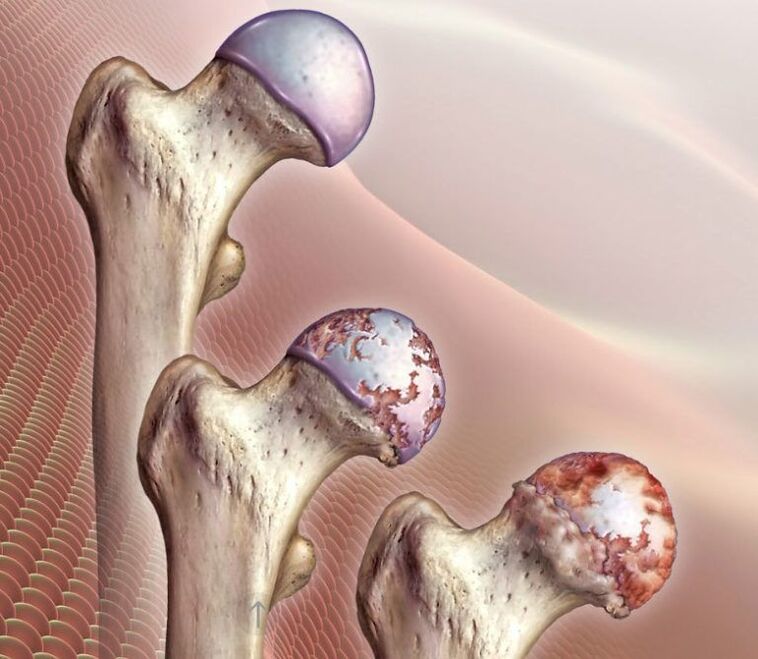 Artróza kyčelního kloubu různého stupně