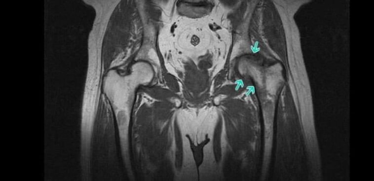 Osteoartróza kyčelního kloubu na MRI