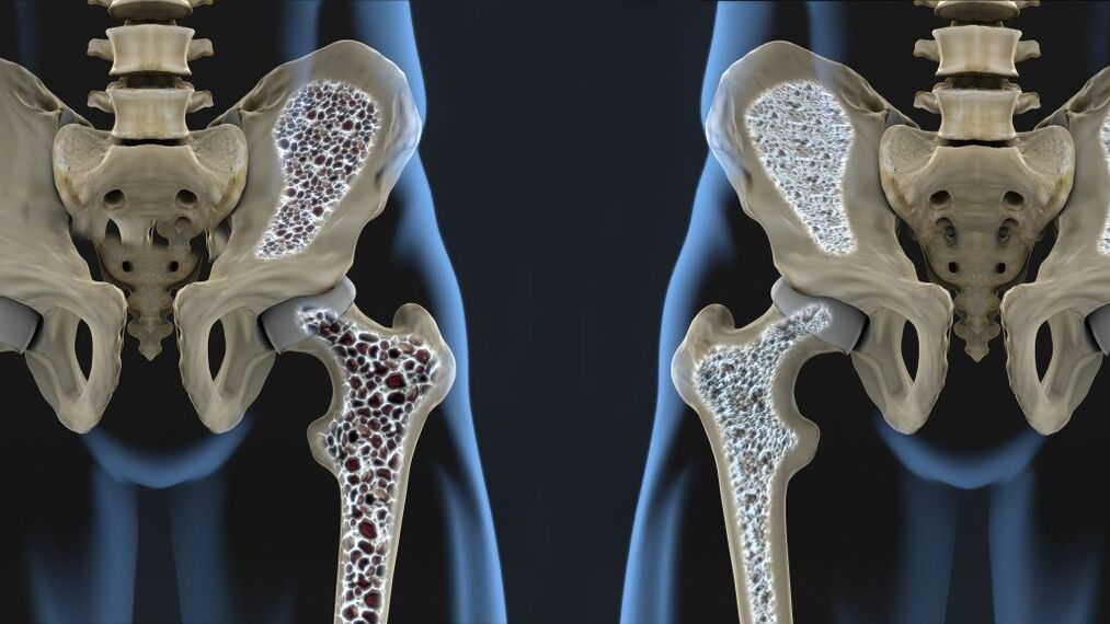 Osteoporóza je příčinou zlomenin kyčle a artrózy kyčle