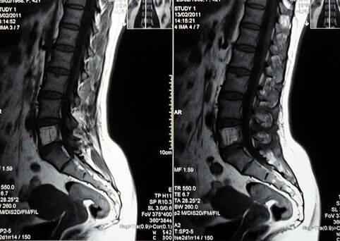 MRI lumbosakrální páteře k diagnostice bolesti dolní části zad